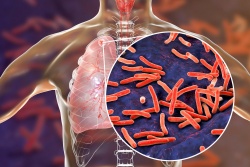Tuberkuloza kosi vse na svoji poti